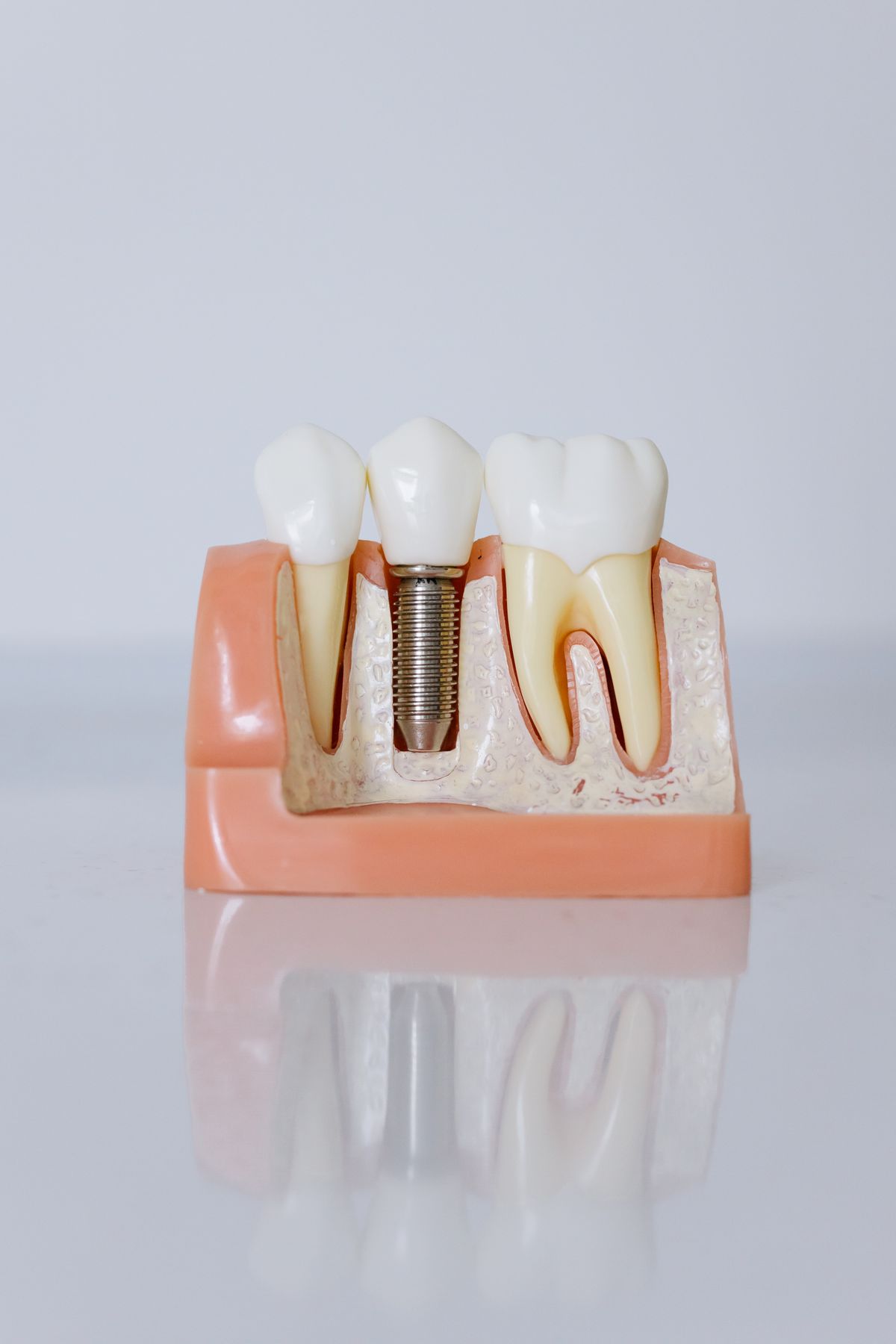 Modelo didático de implante dentário fixado no osso da mandíbula (imagem ilustrativa)