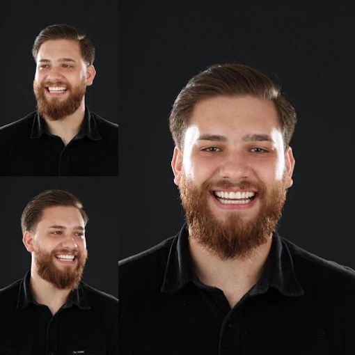 Paciente sorrindo em três ângulos após reabilitação com dentes fixos sobre implantes