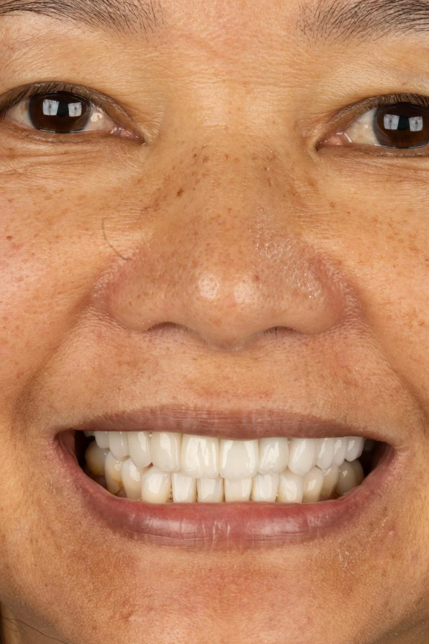 Sorriso da paciente depois do tratamento com facetas de porcelana