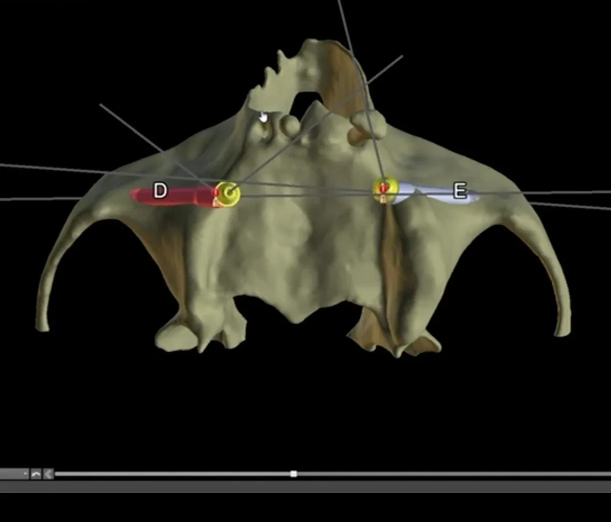 Tomografia em planejamento de implantes zigomáticos do Dr. Michel Moraes