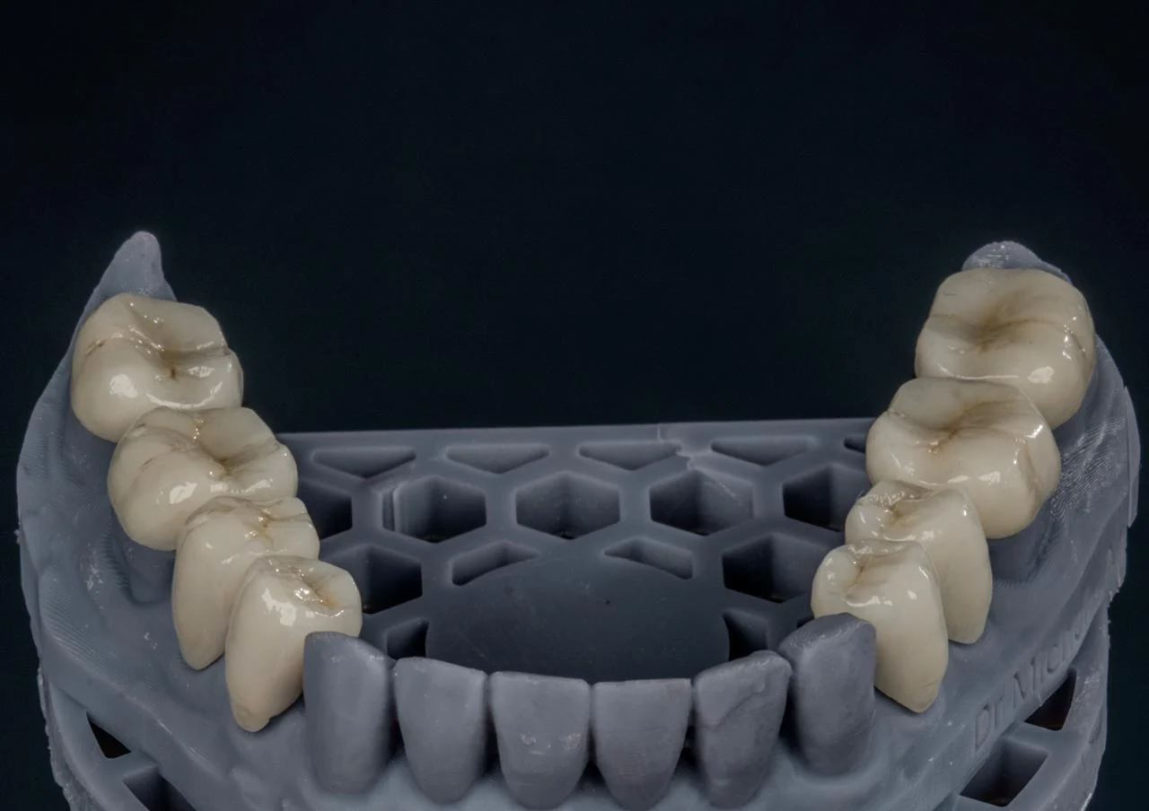 Modelo protético de odontologia restauradora do Dr. Michel Moraes