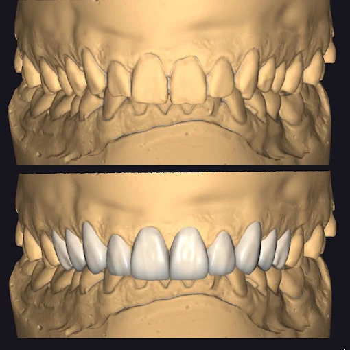 Planejamento digital em 3D do sorriso, com o desenho dos dentes antes de iniciar o tratamento