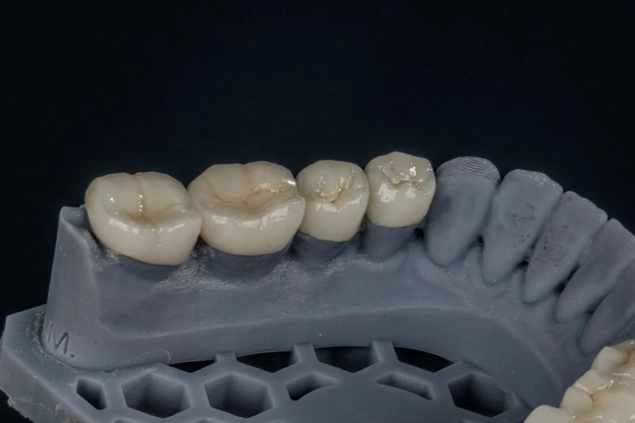 Coroas em modelo de odontologia restauradora do Dr. Michel Moraes