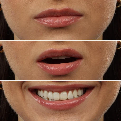 Sequência do sorriso de uma paciente, da boca fechada ao sorriso após reabilitação estética