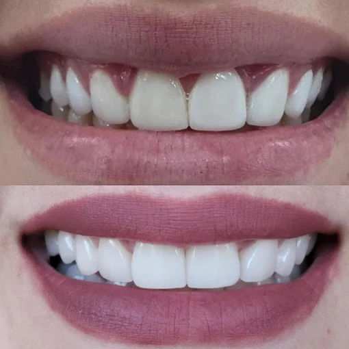 Comparação de sorriso antes e depois de lentes de contato dental