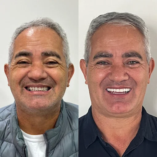 Comparação de sorriso antes e depois da reabilitação oral