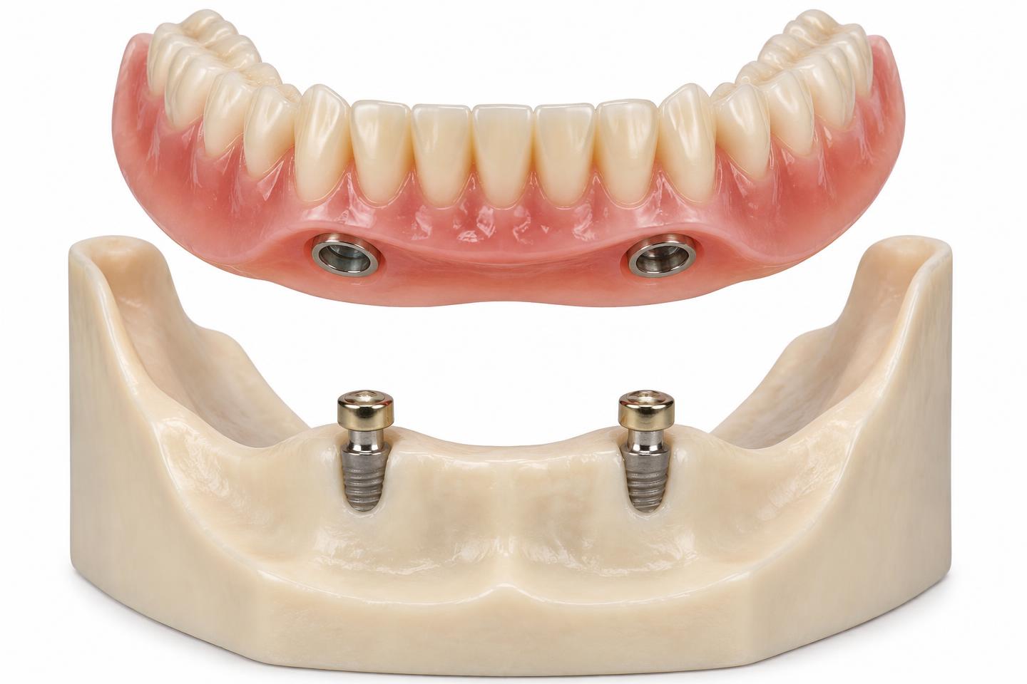 Ilustração didática de overdenture removível sobre dois implantes