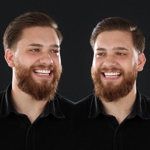 Comparativo do sorriso antes e depois do tratamento