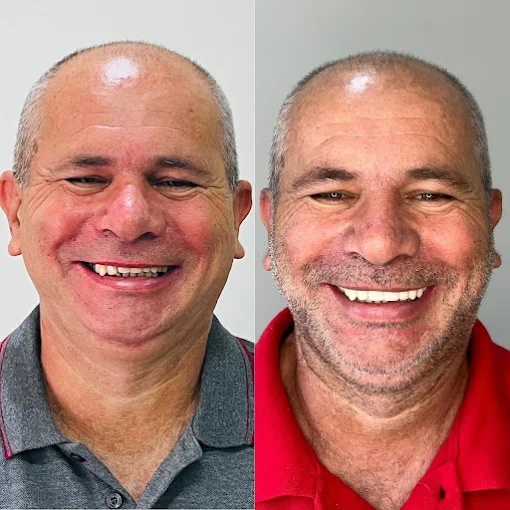 Sorriso reabilitado com prótese fixa